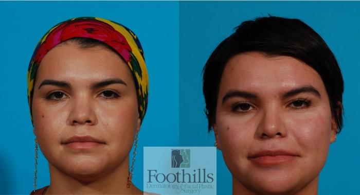 Rhinoplasty Case 146 Before & After Front | Tucson, AZ | Foothills Facial Plastic Surgery