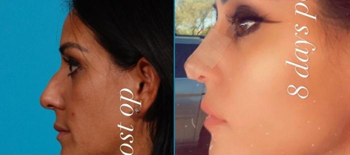 Rhinoplasty Case 147 Before & After Left Side | Tucson, AZ | Foothills Facial Plastic Surgery