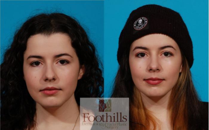 Rhinoplasty Case 149 Before & After Front | Tucson, AZ | Foothills Facial Plastic Surgery