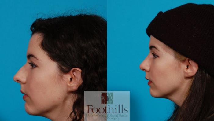 Rhinoplasty Case 149 Before & After Left Side | Tucson, AZ | Foothills Facial Plastic Surgery