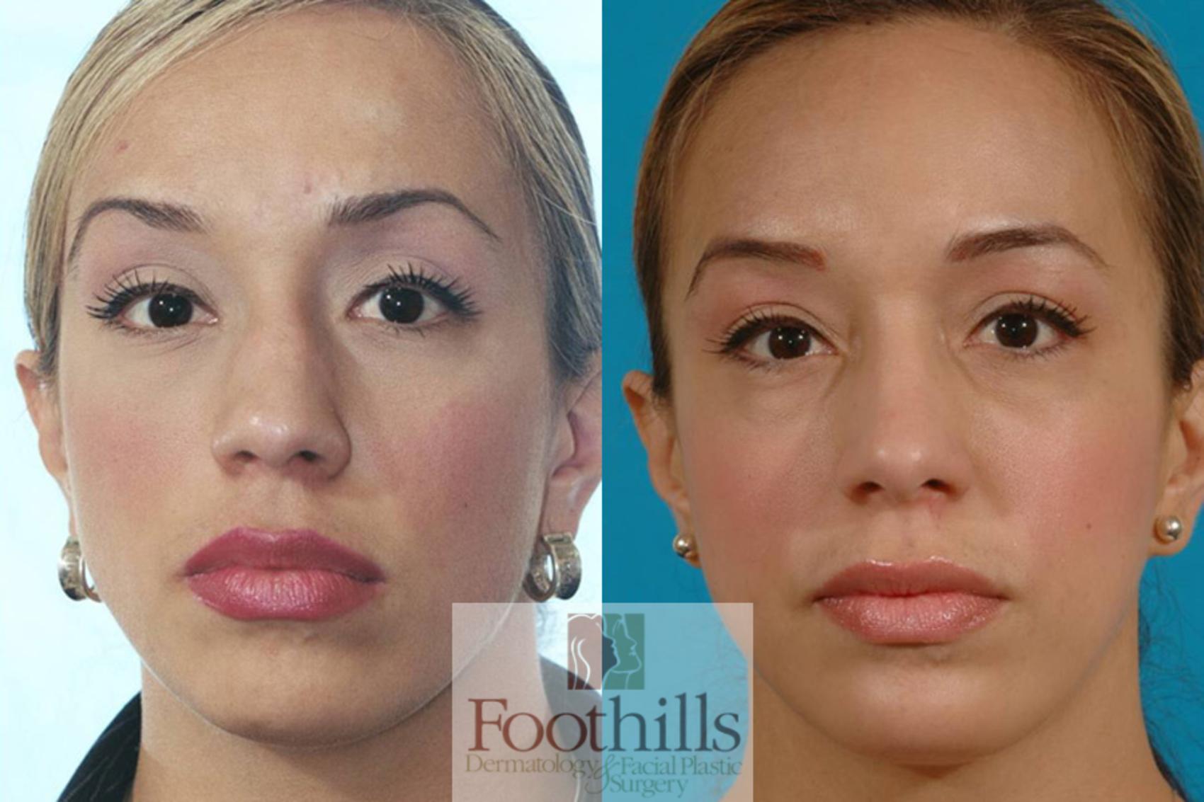 Rhinoplasty Case 15 Before & After View #1 | Tucson, AZ | Foothills Facial Plastic Surgery