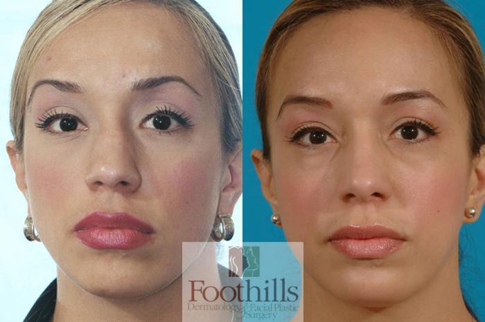 Chin Augmentation Case 15 Before & After View #1 | Tucson, AZ | Foothills Facial Plastic Surgery