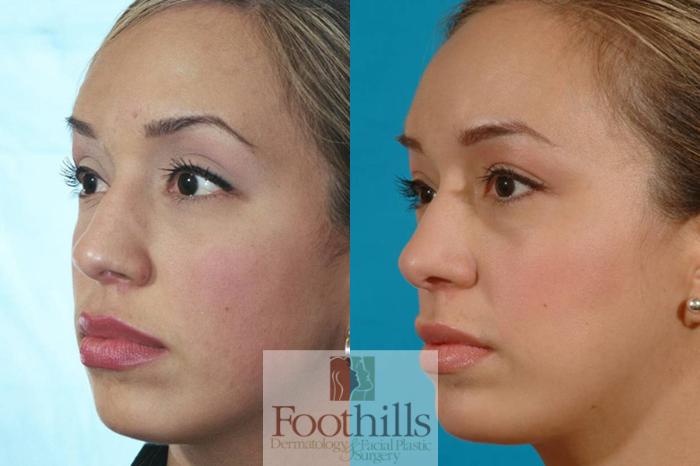 Chin Augmentation Case 15 Before & After View #2 | Tucson, AZ | Foothills Facial Plastic Surgery