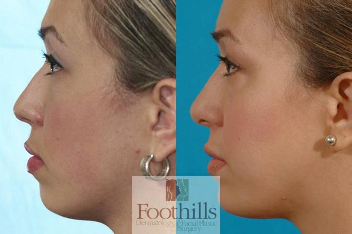 Chin Augmentation Case 15 Before & After View #3 | Tucson, AZ | Foothills Facial Plastic Surgery