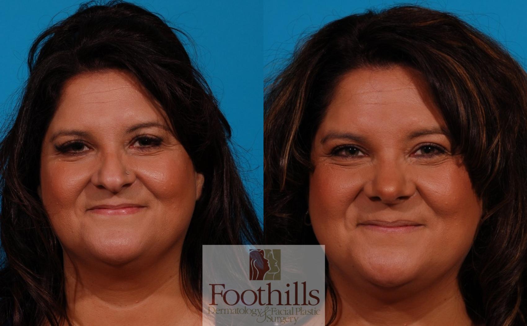 Rhinoplasty Case 157 Before & After Front | Tucson, AZ | Foothills Facial Plastic Surgery