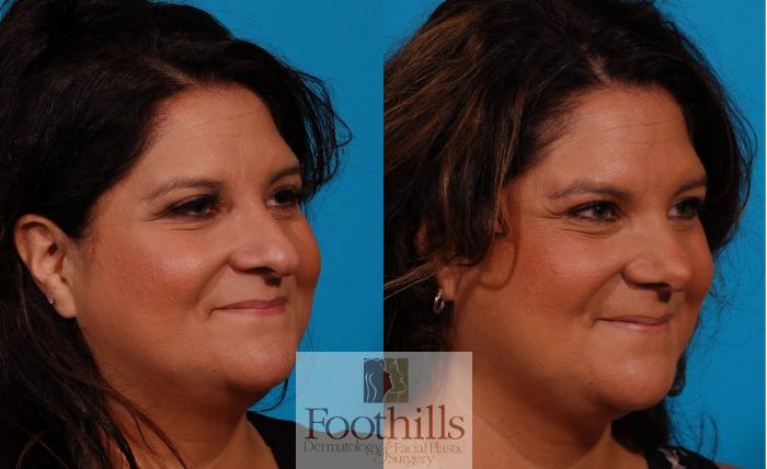 Rhinoplasty Case 157 Before & After Right Oblique | Tucson, AZ | Foothills Facial Plastic Surgery