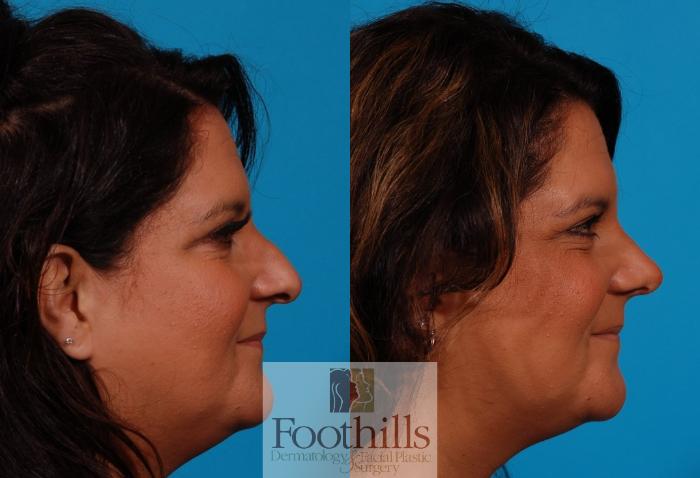 Rhinoplasty Case 157 Before & After Right Side | Tucson, AZ | Foothills Facial Plastic Surgery
