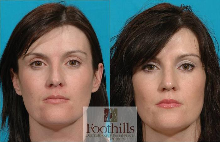Rhinoplasty Case 23 Before & After View #1 | Tucson, AZ | Foothills Facial Plastic Surgery