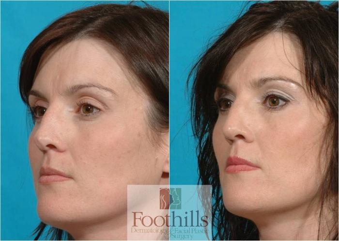 Rhinoplasty Case 23 Before & After View #2 | Tucson, AZ | Foothills Facial Plastic Surgery