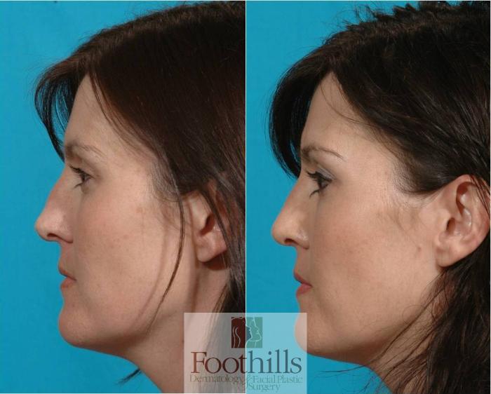 Rhinoplasty Case 23 Before & After View #3 | Tucson, AZ | Foothills Facial Plastic Surgery