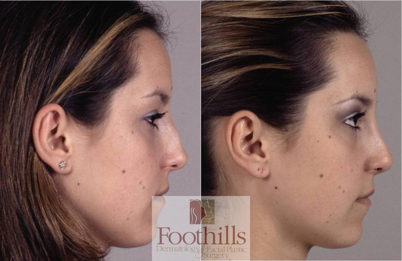 Rhinoplasty Case 24 Before & After View #1 | Tucson, AZ | Foothills Facial Plastic Surgery