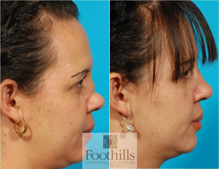 Rhinoplasty Case 32 Before & After View #1 | Tucson, AZ | Foothills Facial Plastic Surgery
