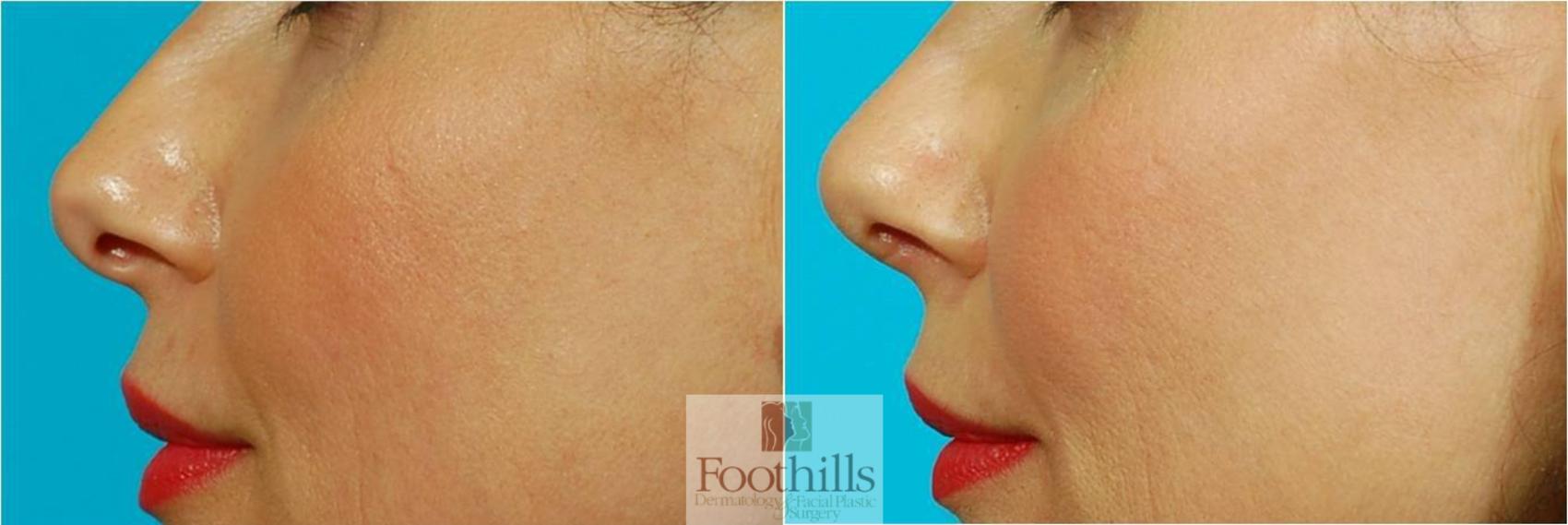 Rhinoplasty Case 69 Before & After View #1 | Tucson, AZ | Foothills Facial Plastic Surgery