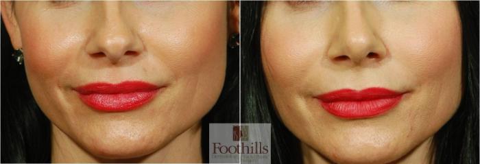Rhinoplasty Case 69 Before & After View #2 | Tucson, AZ | Foothills Facial Plastic Surgery