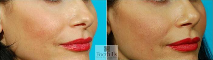 Rhinoplasty Case 69 Before & After View #3 | Tucson, AZ | Foothills Facial Plastic Surgery