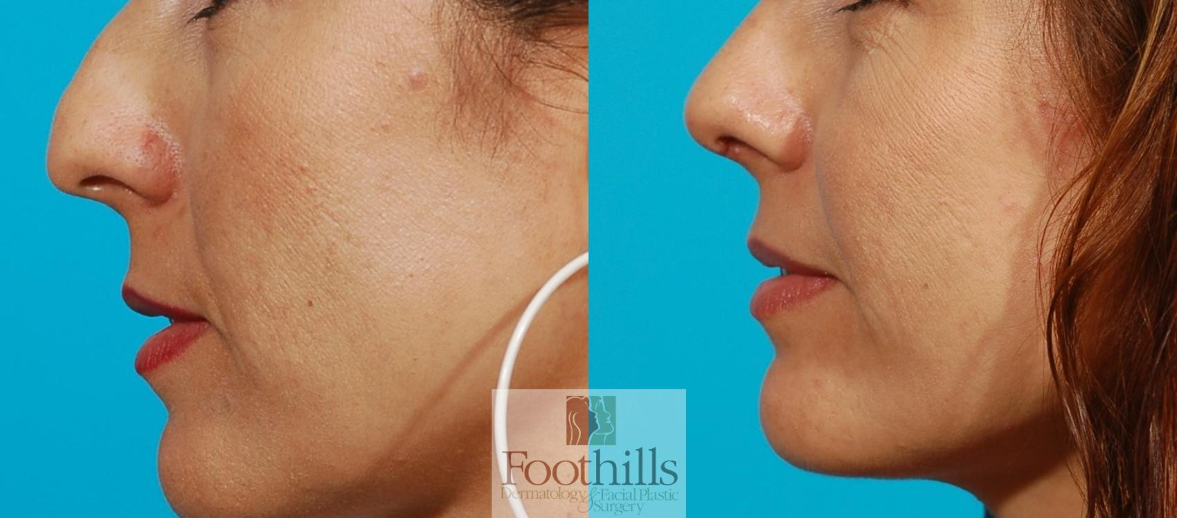 Rhinoplasty Case 72 Before & After View #1 | Tucson, AZ | Foothills Facial Plastic Surgery