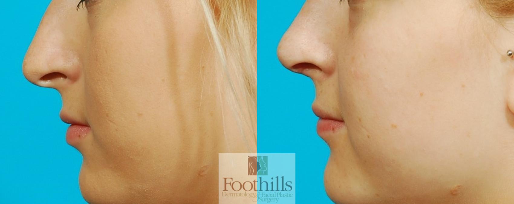 Rhinoplasty Case 73 Before & After View #1 | Tucson, AZ | Foothills Facial Plastic Surgery