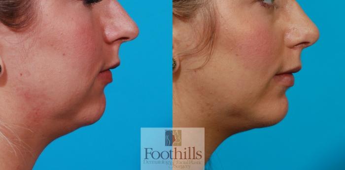 Rhinoplasty Case 74 Before & After View #1 | Tucson, AZ | Foothills Facial Plastic Surgery