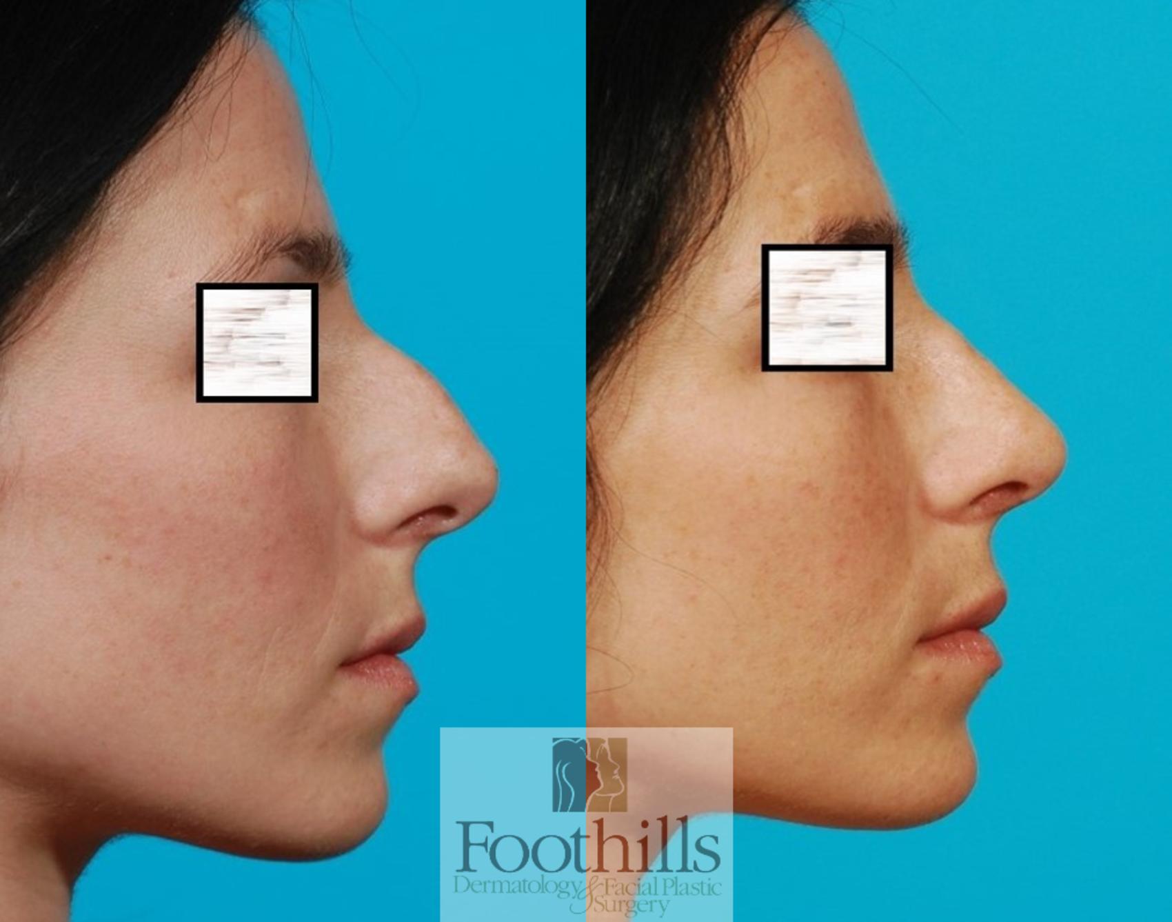 Rhinoplasty Case 77 Before & After View #1 | Tucson, AZ | Foothills Facial Plastic Surgery
