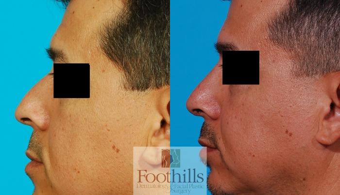 Rhinoplasty Case 84 Before & After View #1 | Tucson, AZ | Foothills Facial Plastic Surgery