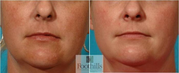 Skin Care Case 28 Before & After View #2 | Tucson, AZ | Foothills Facial Plastic Surgery
