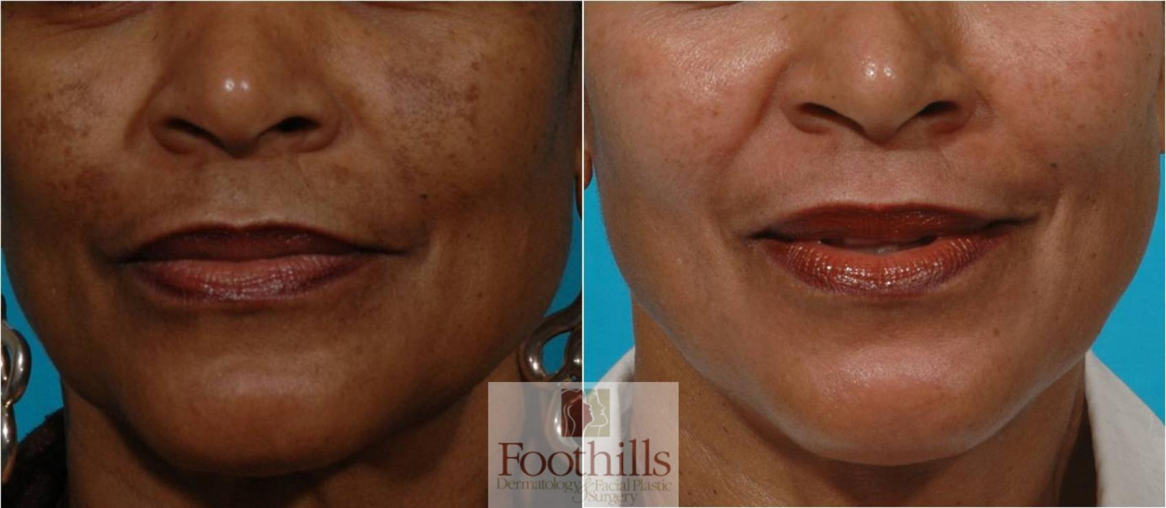Skin Care Case 29 Before & After View #1 | Tucson, AZ | Foothills Facial Plastic Surgery