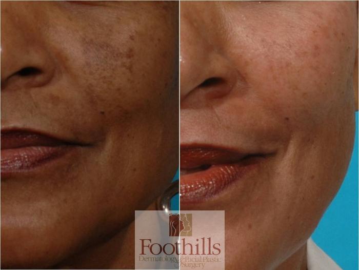 Skin Care Case 29 Before & After View #2 | Tucson, AZ | Foothills Facial Plastic Surgery