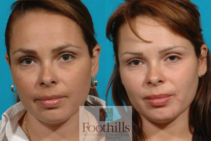 Skin Care Case 5 Before & After View #1 | Tucson, AZ | Foothills Facial Plastic Surgery